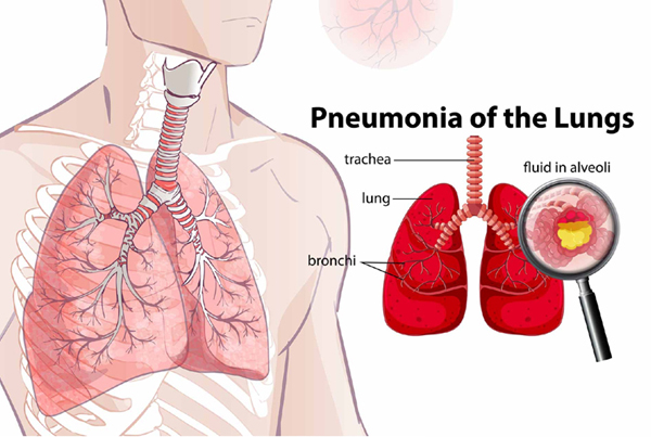 Pneumonia