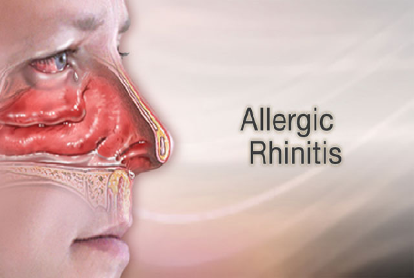 Rhinitis