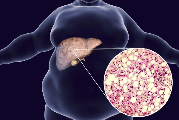 Fatty Liver