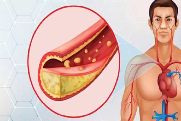 Dyslipidemia