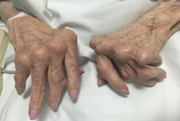 Rheumatoid Arthritis